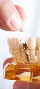 Zahnimplantat bei DRN Zahnarzt